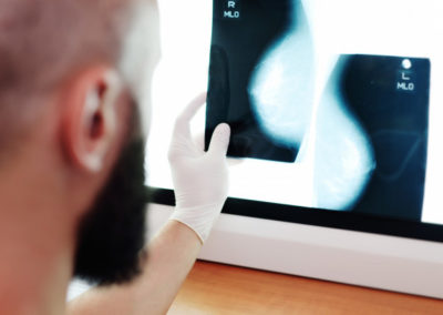 Extensão em Mamografia
